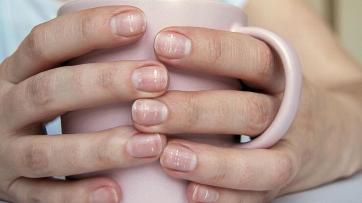 Пятна на ногтях: 10 признаков, которые сигналят о болезнях